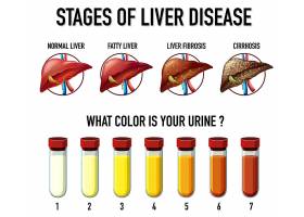 EPS矢量素材下载-肝病分期_11770